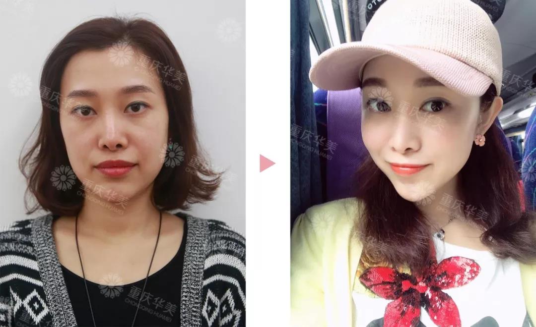 提升做了一年后，臉會不會比以前垮？