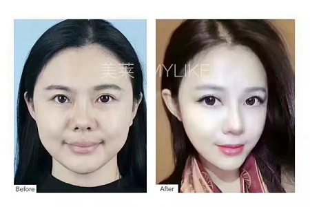 想抗衰，*雕和玻尿酸哪個更適合？