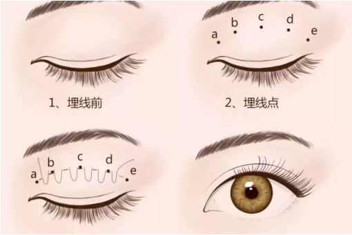 <a href='/zz/' target='_blank'><u>鄭州美萊</u></a>整形埋線雙眼皮做的怎么樣？