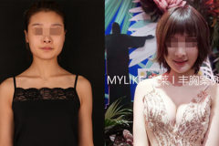 鄭州美萊整形假體豐胸和自體豐胸哪個(gè)好？