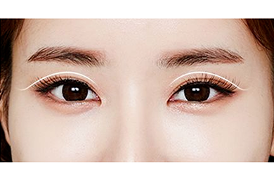 <a href='/zz/' target='_blank'><u>鄭州美萊</u></a>整形做哪種雙眼皮好？