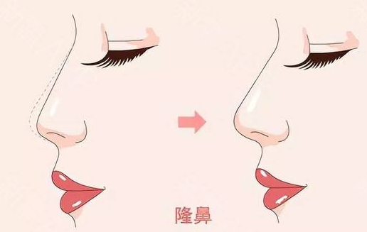 <a href='/zz/' target='_blank'><u>鄭州美萊</u></a>整形醫(yī)院隆鼻有幾種、效果怎么樣？