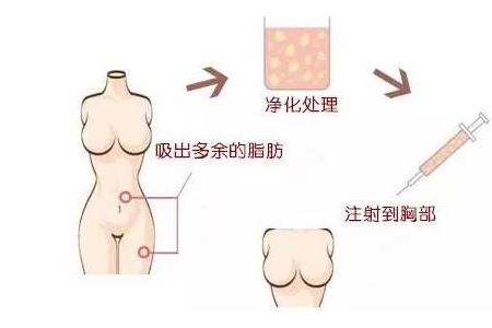 曲靖自體脂肪豐胸維持多久？有哪些優(yōu)點