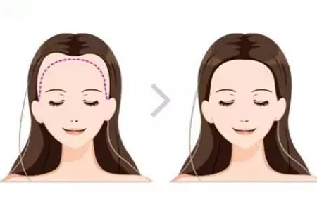 常州發(fā)際線調(diào)整效果好嗎，發(fā)際線如何調(diào)整？