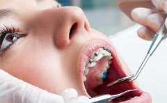 學(xué)生箍牙齒一般多少錢，2023牙齒矯正價格表