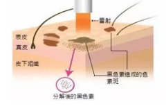 西安整形醫(yī)院做點陣激光多少錢，一次有效果嗎