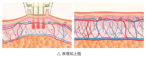 超光子+水光，“撐起”皮膚彈、潤、緊
