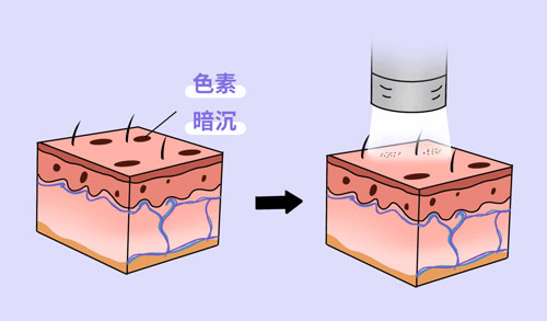 想要嫩膚，應(yīng)該選擇做光電還是水光